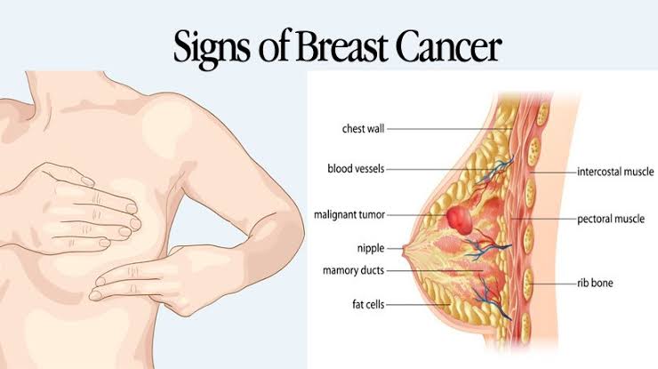 10 EARLY SIGNS OF BREAST CANCER
