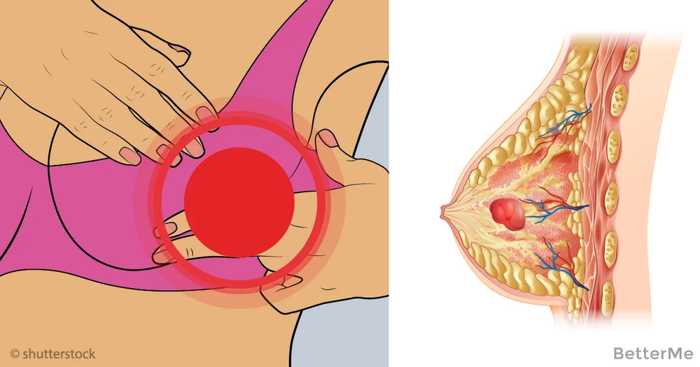 Can Breast Cancer Be Cured Without Chemotherapy