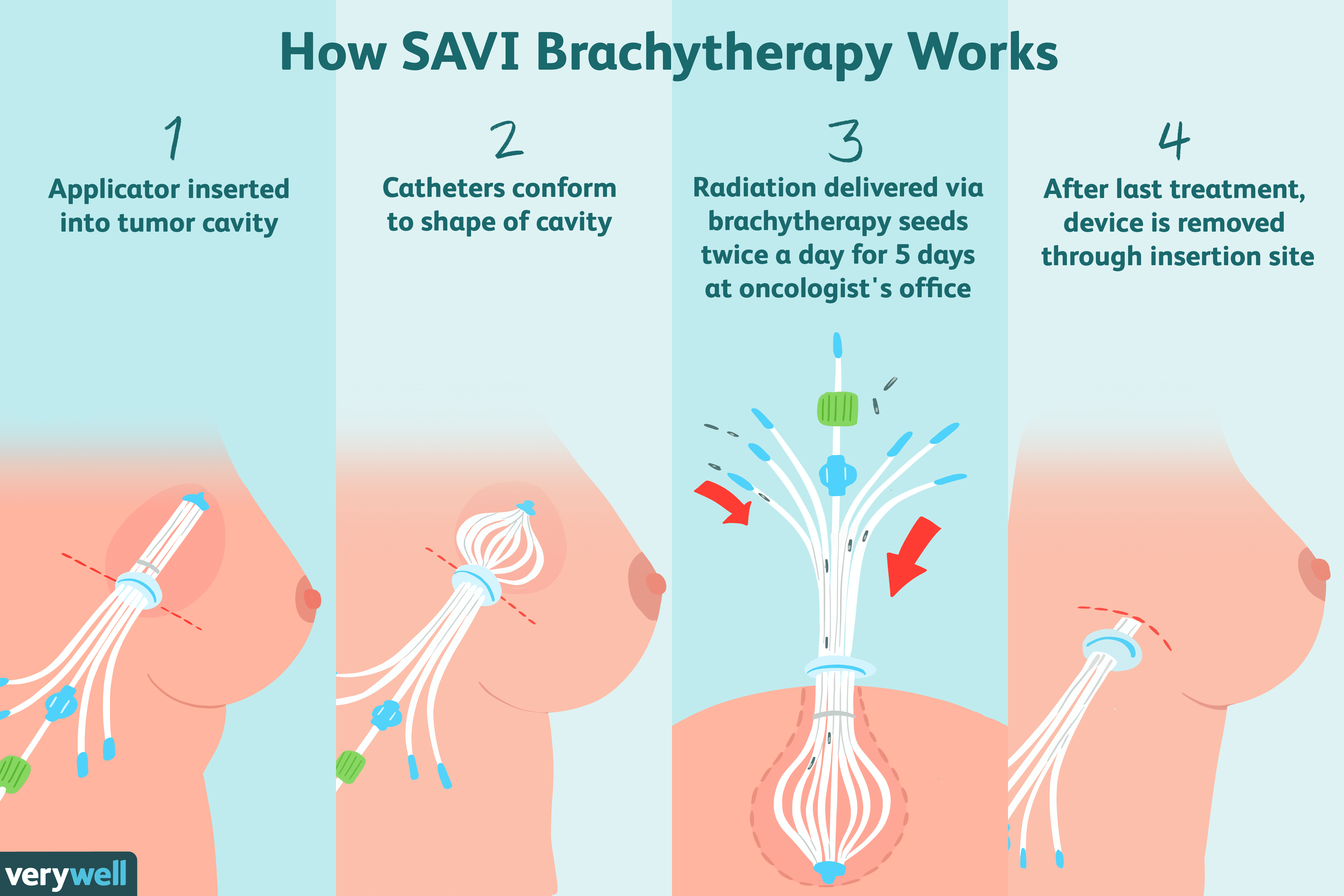 External Beam Radiotherapy Vs Brachytherapy