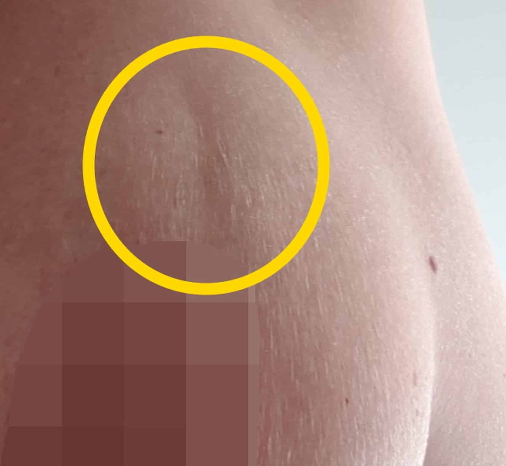 stretch-marks-or-breast-cancer-breastcancertalk