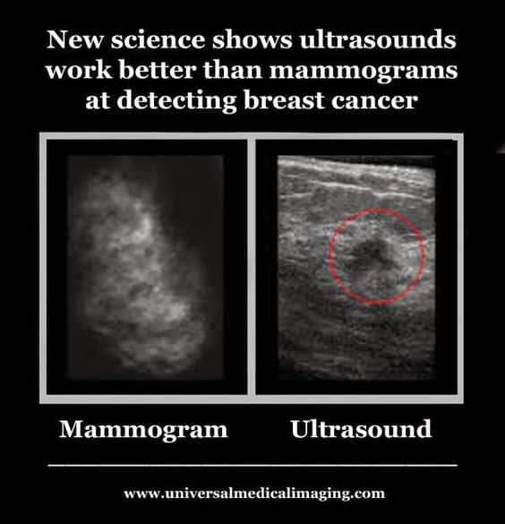 Ultrasound, Breast cancer and Cancer on Pinterest